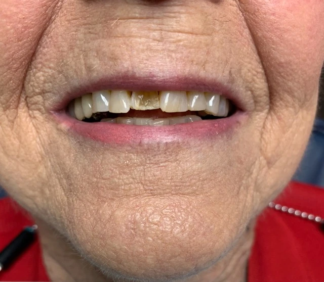 Smile 1, before