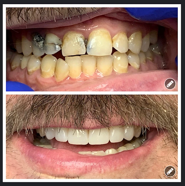 Smile 5 comparison: before on top and after below