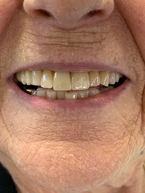 Smile 1, after