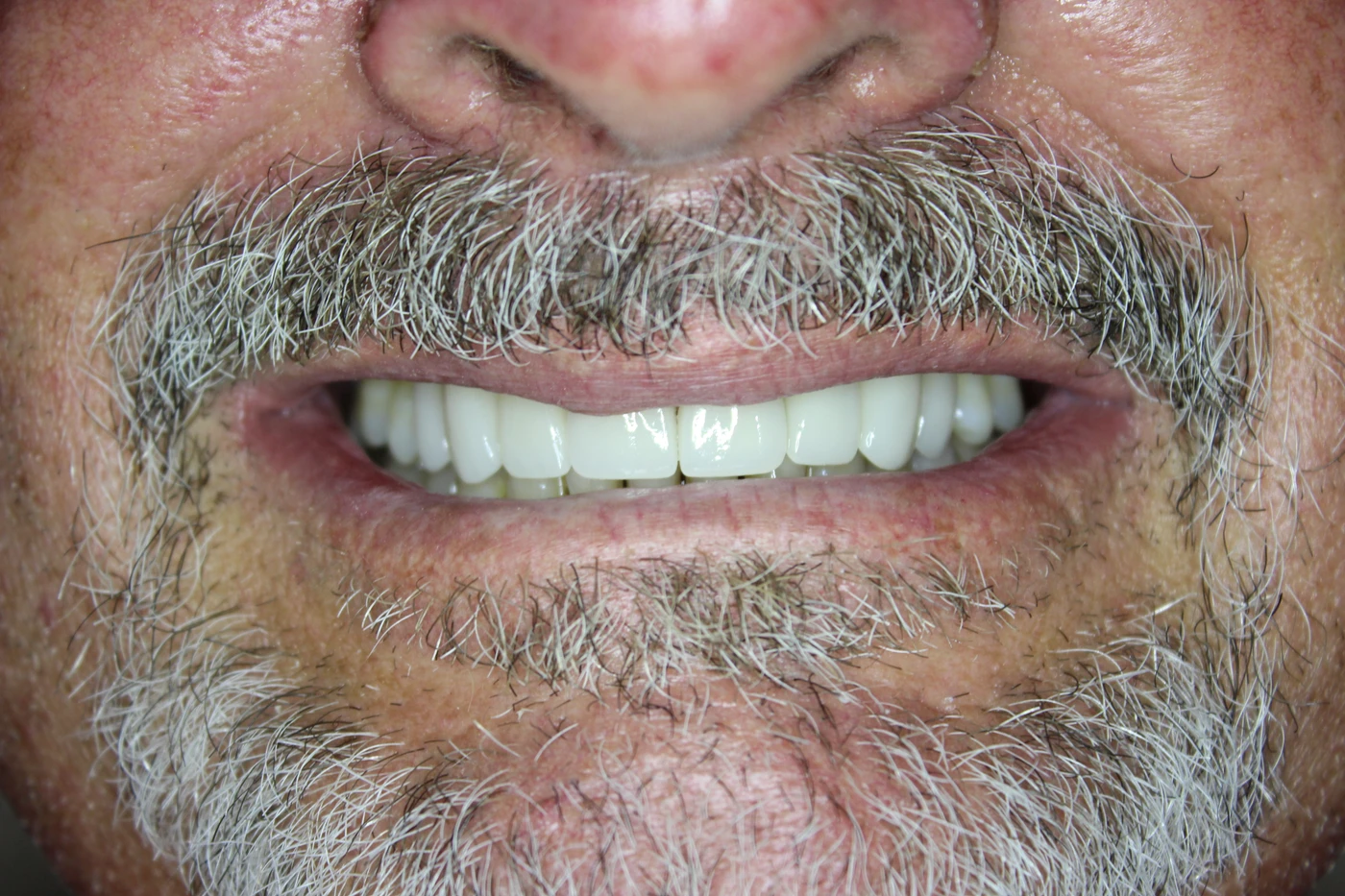 Smile 2, after — close-up