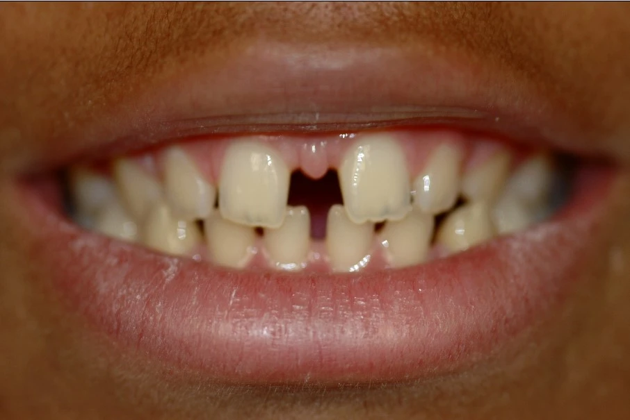 Smile 4, before